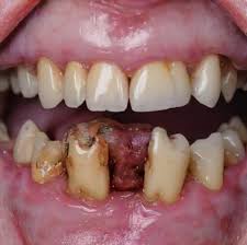 Suboxone Tooth Decay1